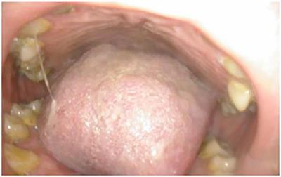 Non-cardiac Manifestations in Adult Patients With Mucopolysaccharidosis